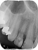 222 ODBORNÉ SDĚLENÍ LKS 10/2018 Obr. 6: Rentgenový snímek zubu 12 s diagnostikovanou ECIR po zahájení endodontického ošetření u praktického zubního lékaře.
