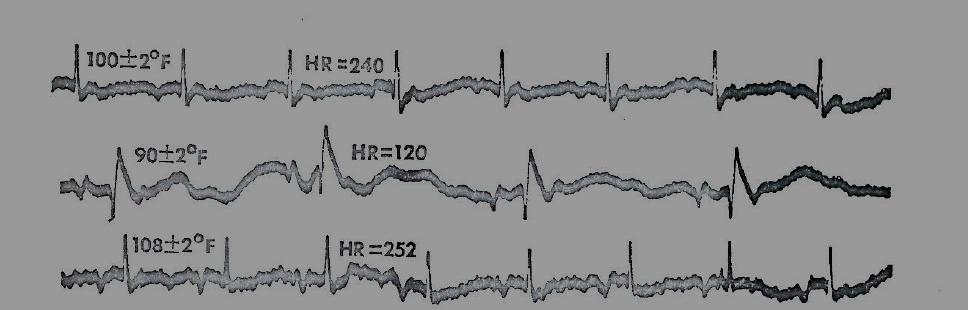 srdce k tělu, byla hypotermní srdce dvakrát větší vzhledem ke kontrolám. Kontraktilita hypotermního srdce byla také dvakrát větší in vitro, ale in vivo hodnoty vyšly přesně naopak.