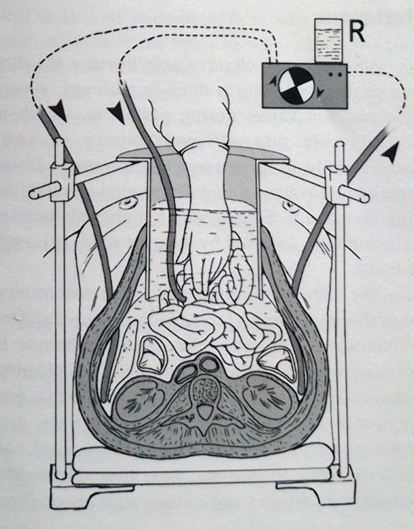 Obr.3 Schéma HIPEC Zdroj: GIORGIO, Angelo; PINTO, Enrico. Treatment of Peritoneal Surface Malignancies: State of the Art and Perspectives. Milano: Springer Milan, 2015. ISBN 978-88-470-5711-1. Obr.