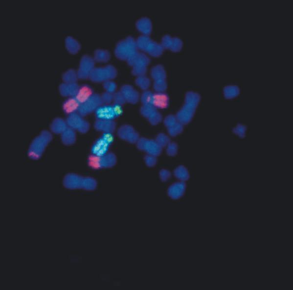 CYTOGENETIC ANALYSIS FISH analysis t(ab);t(ab);t(ba) Three