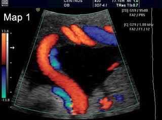 barevný Doppler barevné dopplerovské mapování průtoku, Color Doppler Imaging (CDI), Color Flow Mapping (CFM) v B-obrazu je definovaná výseč, ze které je dopplerovská informace o pohybu (rychlosti