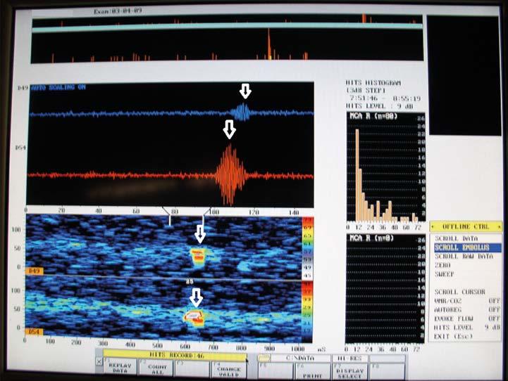 Obr. 1. Mikroembolus (šipka) detekovaný pomocí transkraniální dopplerometrie nebo technik automatické detekce embolu.