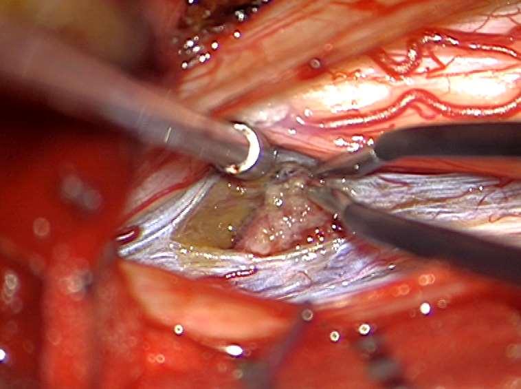 DREZ Sulcus