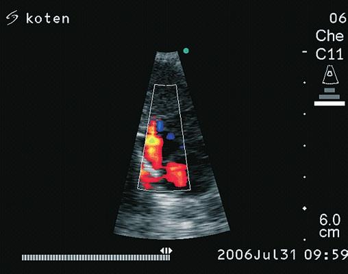 NEOBVYKLÁ PŘÍČINA DUŠNOSTI Echokardiografické vyšetření Po měsíci vyšetřování se pacient dostává opět do plicní ambulance se stále neobjasněnou příčinou zhoršující se dušnosti a celkového stavu