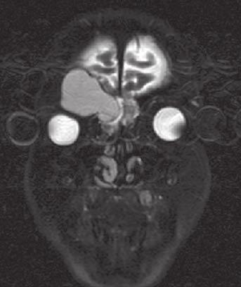 2: MRI frontální oblasti (první pacient) transversální řez Obr. č.