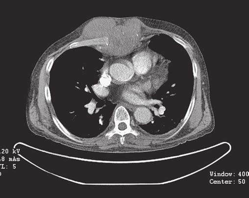 Metastáza sterna jako první projev hepatocelulárního karcinomu Václav Šimánek 1, Vladislav Třeška 1, Petr Mukenšnábl 2, Antonín Fikrle 3, Jiří Klečka 1, Tomáš Skalický 1, Alan Sutnar 1, Vladimír