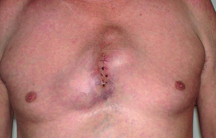 METASTÁZA STERNA JAKO PRVNÍ PROJEV HEPATOCELULÁRNÍHO KARCINOMU Obr. č. 2: Deformace přední hrudní stěny metastázou hepatocelulárního karcinomu žovat na pálivou bolest za sternem.
