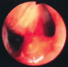 Zajímavé bronchologické (a morfologické) nálezy Pavel Bartoň 1, Martin Drajna 1, Zoltán Kerekes 2 1 OLÚ Jevíčko 2 Patologie, s. r. o., Litomyšl Bartoň, P., Drajna, M., Kerekes, Z.