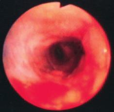 Následující případ, u něhož jsme viděli celou řadu endobronchiálních změn granulace, nespecifické bronchitické změny i antrakofibrotické pigmentace (Rikimaru et al. 1994; podrobně viz 1.