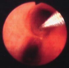července 2000. Na RTG dokumentaci (přehledný snímek a pravý boční snímek hrudníku ze 3. května 2000) jsou hilové kalcifikáty a změny charakteru syndromu středního laloku.