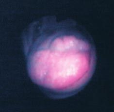 ZAJÍMAVÉ BRONCHOLOGICKÉ (A MORFOLOGICKÉ) NÁLEZY Dříve časté postižení jiných oddílů dýchacích cest než průdušnice a průdušek je dnes vzácné.