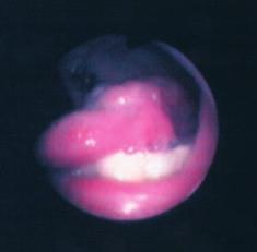 11/4 Foto z archivu autorů Pacientka byla léčena čtyřkombinací antituberkulotik Nidrazid, Rifadin, Sural, Streptomycin.