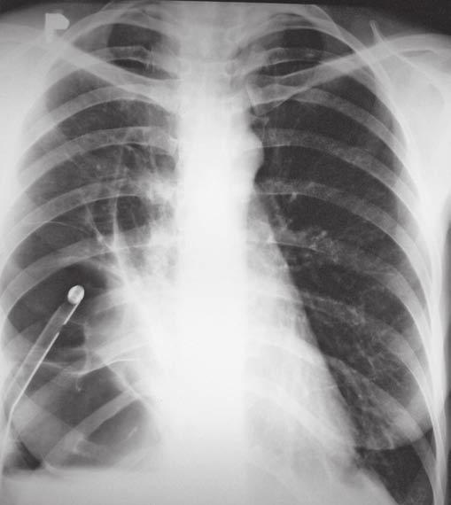 Rarita Autohemopleurodéza a její možné komplikace Pavla Žáčková Autohemopleurodéza je metodou, která je stále úspěšně používána k léčbě přetrvávajícího úniku vzduchu u nemocných se sekundárním