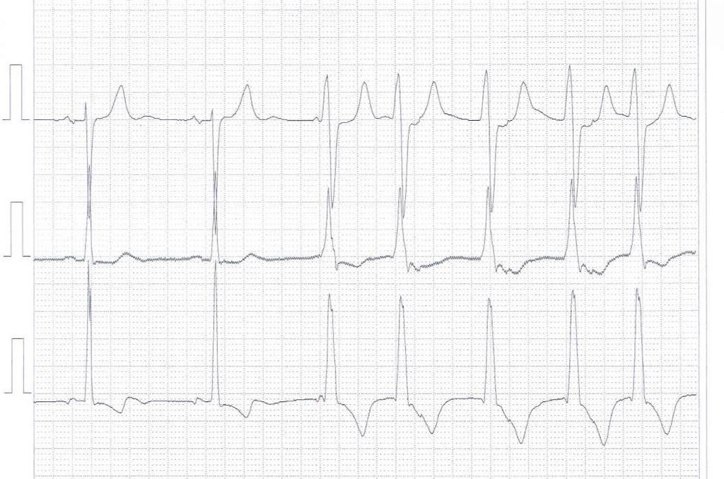 Akcelerovaný idioventrikulární rytmus Ektopický komorový rytmus (>3 stahy) o frekvenci rychlejší než má SR a