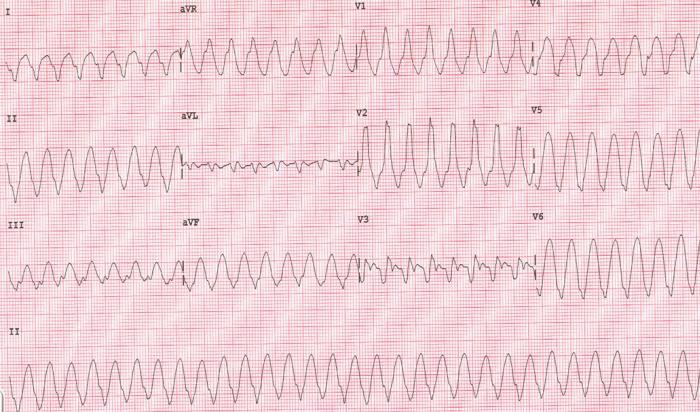 Komorové tachykardie (KT) Organizovaná komorová aktivita (>3 stahy) s frekvencí > 100/min QRS > 120ms (QRS <