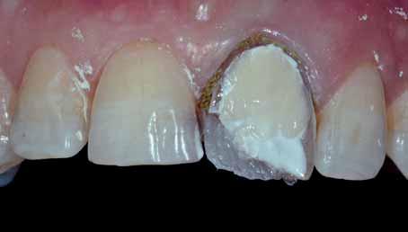 Systém byl navržen s cílem usnadnit a urychlit práci zubním lékařům při tvorbě přímých kompozitních fazet značně omezuje nutnost komplikované modelace.