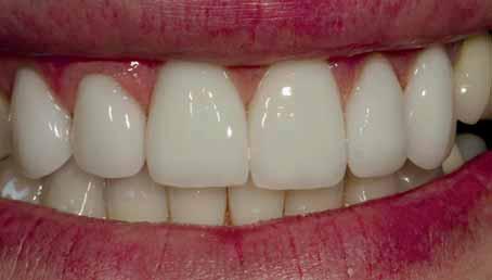 25: Hotové keramické fazety na zubech 13 23 byl poté nanesen do šablony Uveneer a spolu s ní přitlačen k labiálnímu povrchu příslušného zubu (obr. 21).