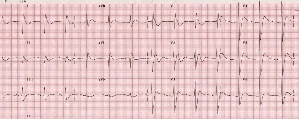 Hyperkalcémie EKG změny Zkrácení QT intervalu