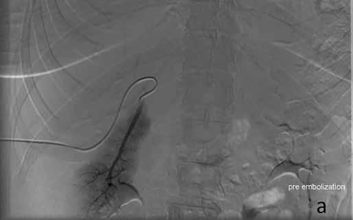 Obr. 1A Obr. 1B Obr. 1. Před (A) a po (B) embolizaci pravé větve porty Fig. 1. Before (A) and after (B) the right portal vein embolization SIM, proveden kontrolní nástřik k ozřejmění anatomických poměrů portálního řečiště.