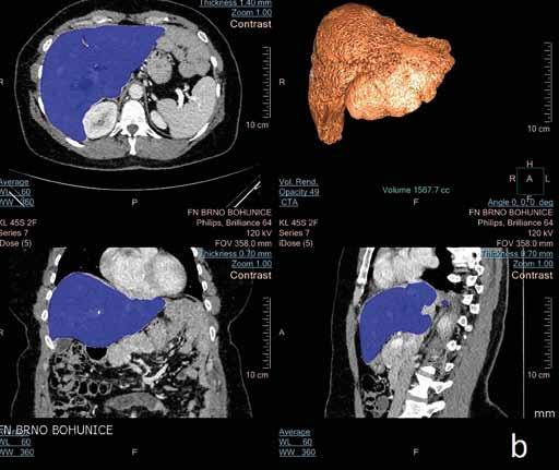 Volumetrické hodnocení Volumetrické hodnocení bylo prováděno semiautomaticky dvěma nezávislými radiologys 1 a 4 roky praxe s touto metodou pomocí programu Intellispace Portal 5,0 (Philips, Amsterdam,