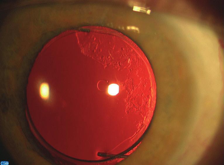 VÝSLEDKY U sedmi očí (5 pacientů) byla provedena Nd: YAG kapsulotomie, u dvou očí s IOČ AcrySof a u pěti očí s IOČ Allergan.