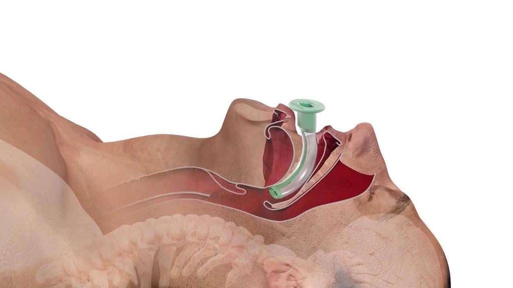 The guedel pattern airway Nestyď se jej použít vyřeší jednodušše can