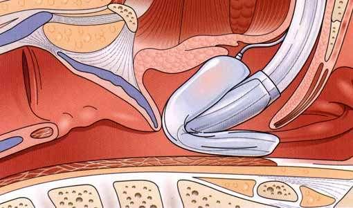 Seal with the respiratory tract Malpozice II.