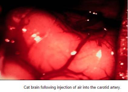 Arteriální vzduchová embolie AKB, ECMO, Ruptura balónku intraaortálně Kanylace arterie