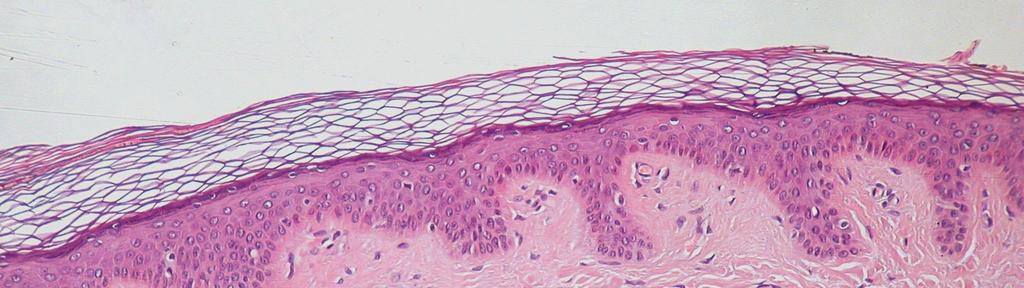 NANOPROGRESS UZDRAVUJE ZRANĚNÍ KŮŽE Díky metodě přípravy koaxiálních nanovláken byly vyvinuty kožní kryty,