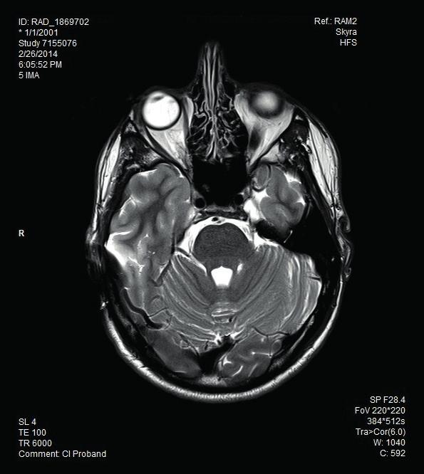 V levém obrázku jsou uvedeny artefak ty, získané umístěným magnetem implantátu, zatímco obrázek vpravo zachycuje artefakty zobrazení, kde magnet