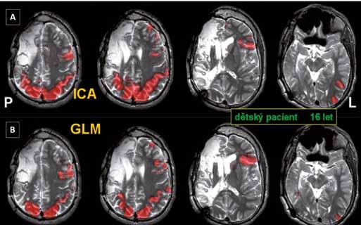 Obr. 4 Obr. 4. Zobrazení mozkových sítí pomocí klidové fmri.