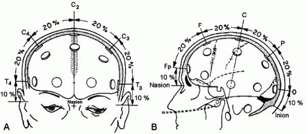 2.2 Rozložení elektrod Možností rozložení elektrod na hlavě pacienta je nepřeberné množství. Také počet elektrod se může měnit v závislosti na požadavcích vyšetření, které je prováděno.