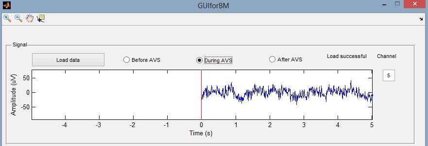 Po pravé straně tlačítka Load data jsou umístěny tři radiobuttony, kterými si uživatel zvolí, jestli chce načíst data z měření před použitím AVS (Before AVS), při stimulaci AVS (During AVS), anebo po