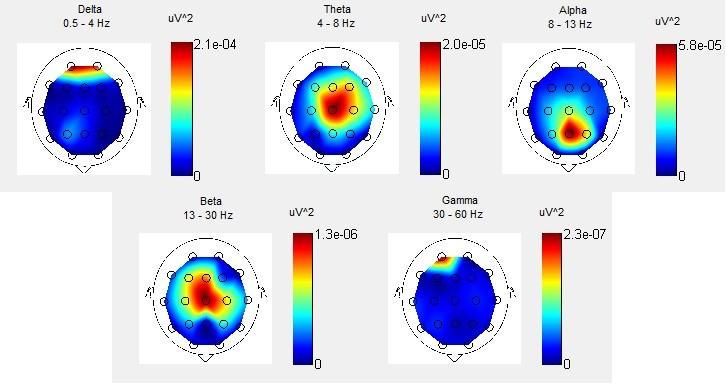 Obrázek 24 - Frekvenční BM po AVS. Obrázek 22 zobrazuje frekvenční topografické mapování z povrchu hlavy před využitím AVS. Můžeme vidět zvýšený výkon v oblasti pásma alfa a delta.