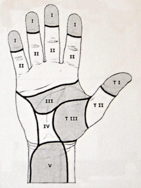 Obrázek 5: Zóny poranění flexorů (Sukop, 2013) 2.10.3 Poranění extenzorů Extenzory se nachází na dorzální straně předloktí, zápěstí a prstů.