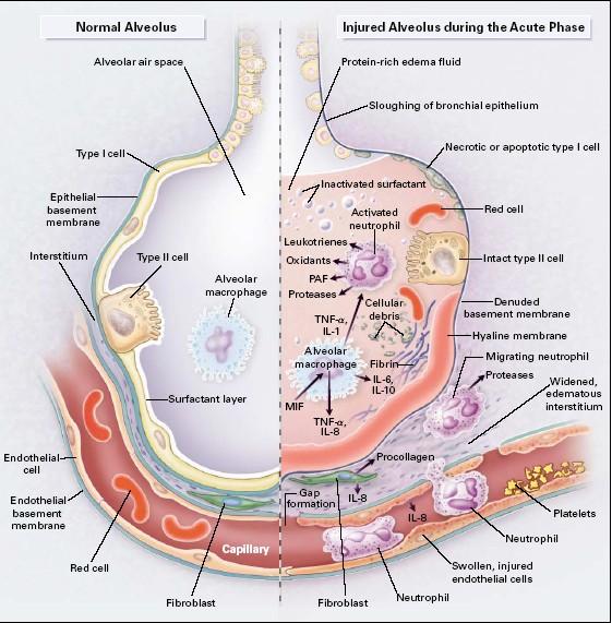 Infiltrace neutrofily Tekutina se serovými proteiny Porucha BM Destrukce alveolárních bb. I. +II.
