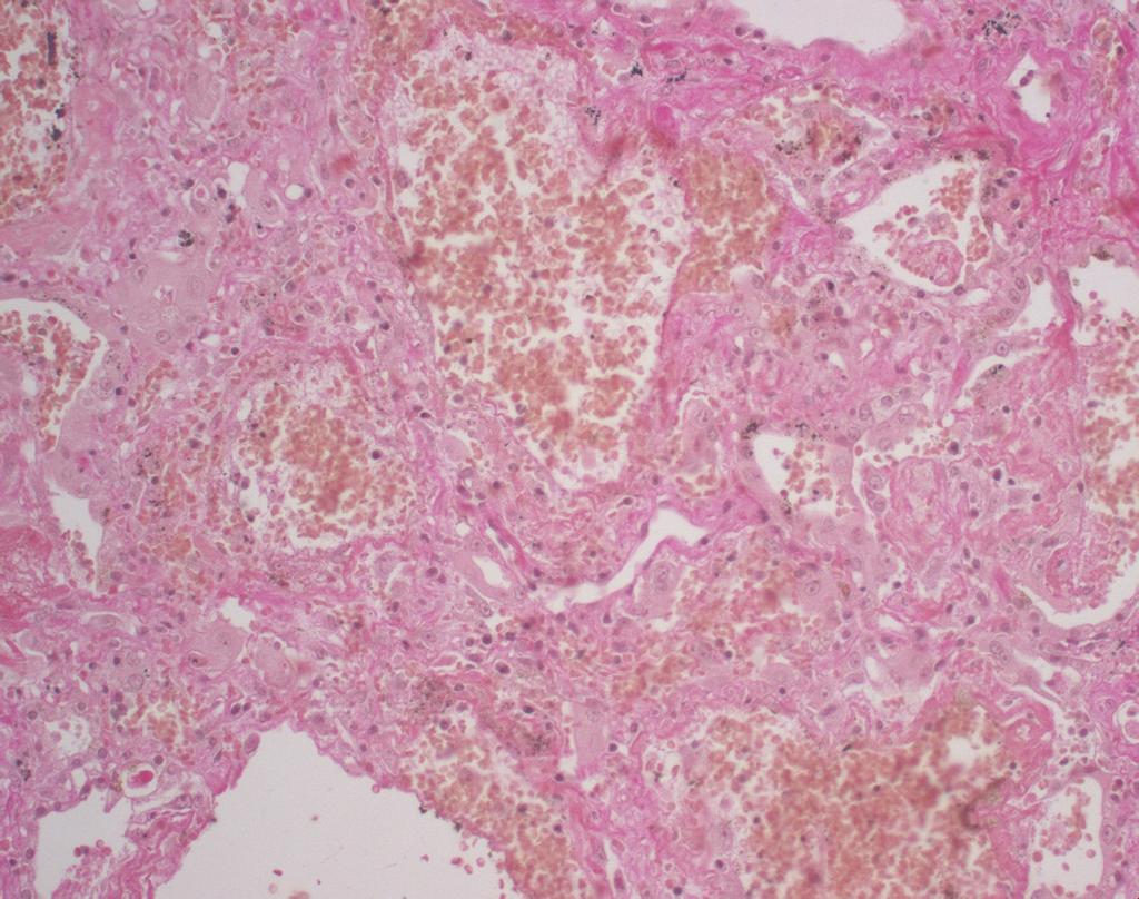 organizovaná bronchioloalveolitida, dále jsou patrné hyalinní membrány na stěnách alveolů a také