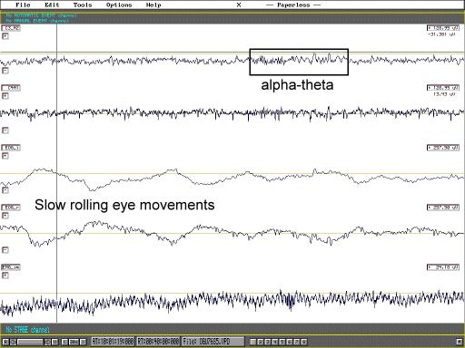 1.stadium NonREM EEG: rozpad α aktivity,