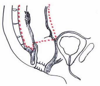 Summary Backgrounds: Neoadjuvant chemotherapy is a standard preoperative therapeutical procedure with locally advanced rectal adenocarcinoma.