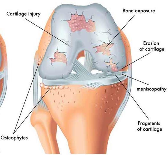 Přehled současného stavu poznání Osteoartróza Nerovnováha mezi syntézou a degenerací chrupavky nadměrné opotřebení Nadměrné zatížení zvýší aktivitu chondrocytů, které začnou produkovat enzymy