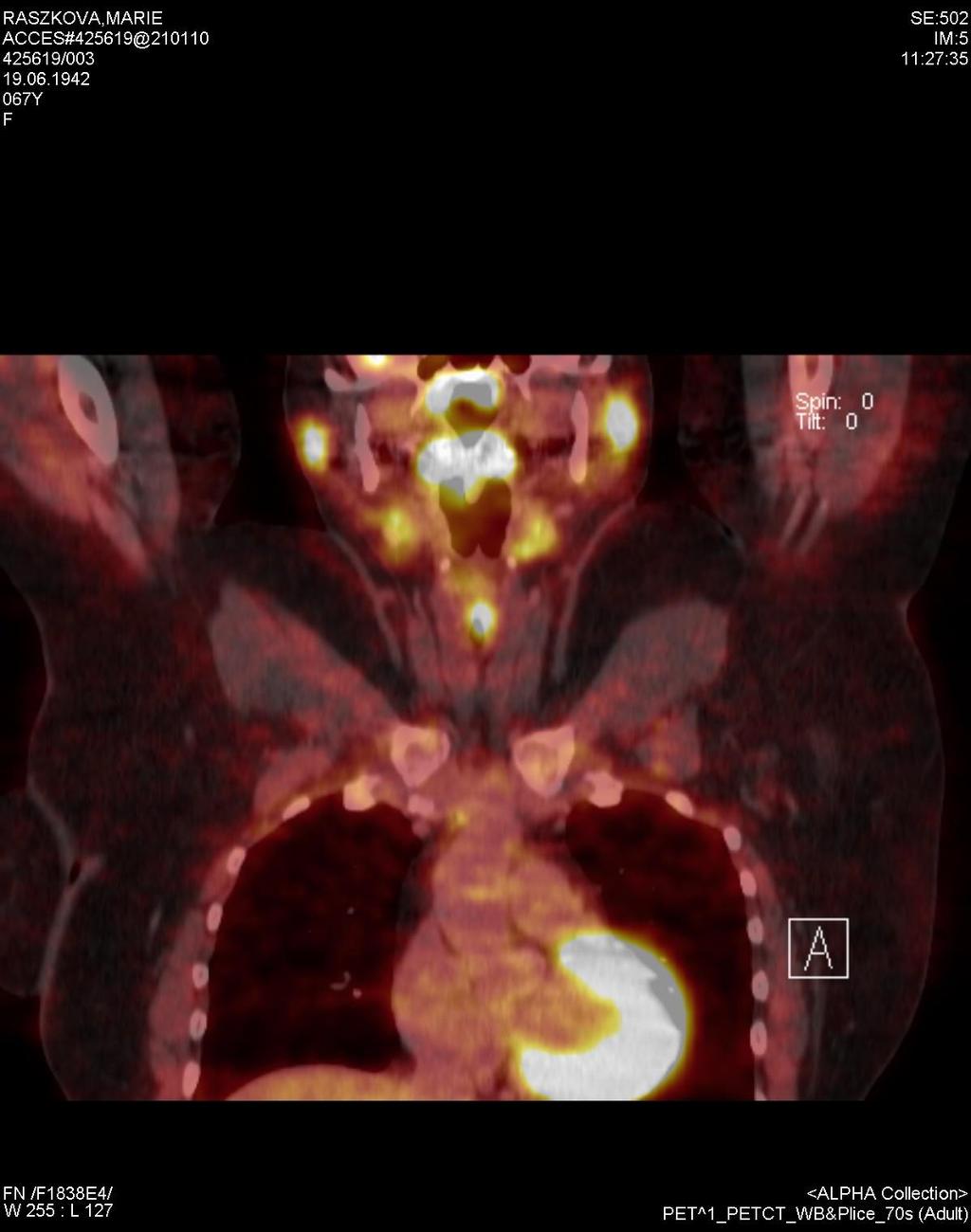 PET-CT Lymfom příušních žláz