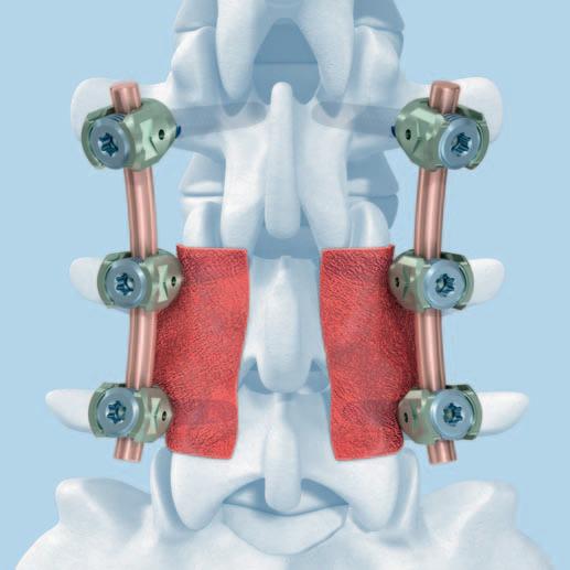 Biomateriály a implantáty Pro usnadnění fúze se kostní štěp často vkládá do laterálních drážek. Vhodná náhrada kostního štěpu (např.