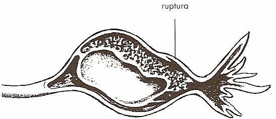 2. Tubární potrat: tubární těhotenství nacházející se v ampulární části tuby odumírá a odlučuje se od sliznice tuby a jeho zbytky jsou následně vypuzeny peristalitikou vejcovodu do pánevní dutiny.
