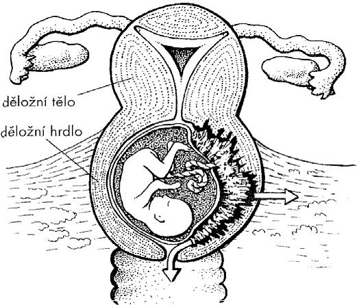 nerozpoznaný. Žena je schopna donosit plod do pozdních stádií těhotenství, ale po následujícím potratu však dochází k masivnímu, často život ohrožujícímu krvácení z neodlučující se placenty.