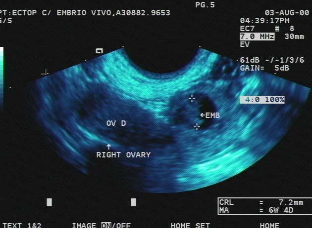 Obr 5. Ektopická gravidita na UZ 4.5 Invazivní diagnostické metody 4.5.1 Laparoskopie Jedná se o endoskopickou diagnostickou a operační metodu která je používána v gynekologii pro vyšetření vnitřních rodidel ženy.
