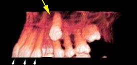 (b) 3D CT rekonstrukce (volume renndering) ukazuje palatinální kořen levého prvního premoláru bez resorpce (modrá šipka).