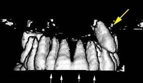 (c) 3D CT rekonstrukce (volume rendering) (boční pohled).
