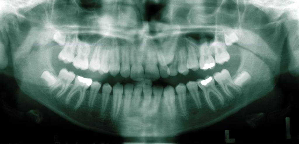 Nejedná se tedy o primární dystopii špičáku. Obr. 3b Ortopantomogram stejného chlapce z předchozího obrázku zhotovený ve věku 14 let a 2 měsíce.