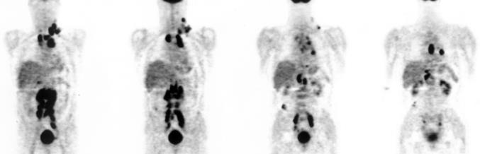v čem může nukleární medicína přispět radioterapii a onkologické léčbě?
