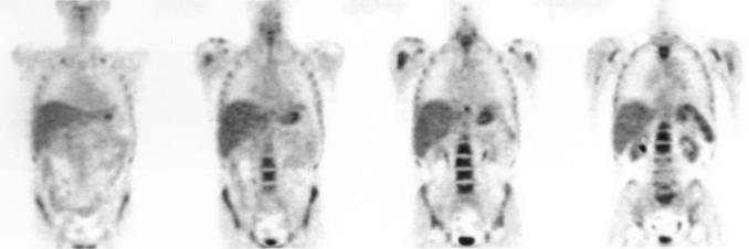 rozsáhlá ložiska B non-hodking lymfomu Efekt léčby Po chemoterapii: téměř úplné vymizení fyziolog.